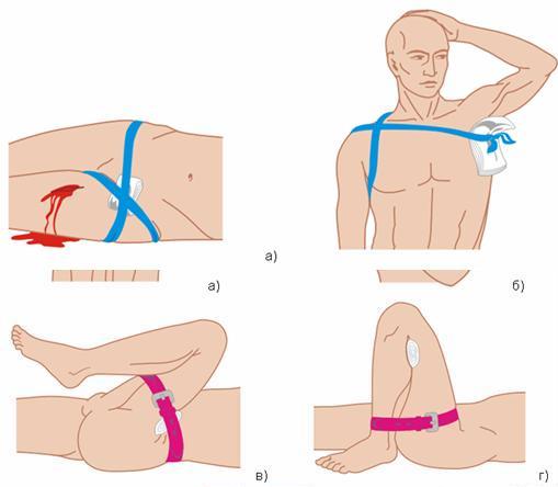 Остановка кровотечения с помощью резинового жгута: а) наложение жгута при кровотечении из раны в верхней трети бедра; б) наложение жгута при кровотечении из раны в верхней трети плеча 