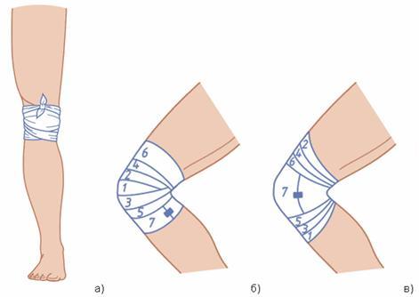 Повязки на колено: а) галстучная; б) черепицеобразная расходящаяся; в) черепицеобразная сходящаяся 